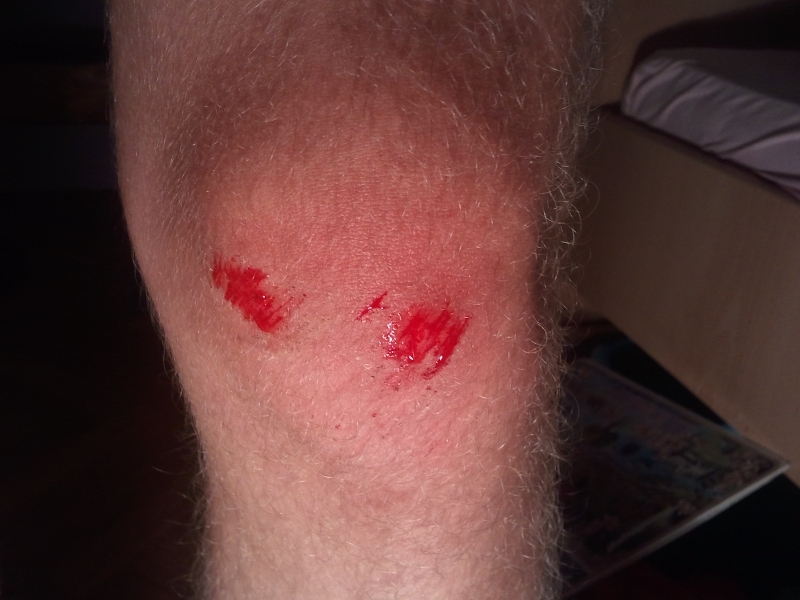 Eitt av mine mange skrubbsÄr. Det ligg verkeleg an til at dette vert eit hardt Är for helsa.